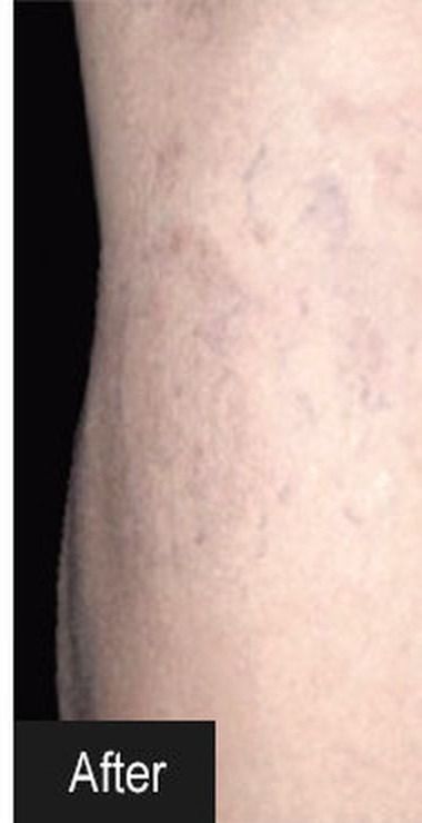 After thread vein removal treatment