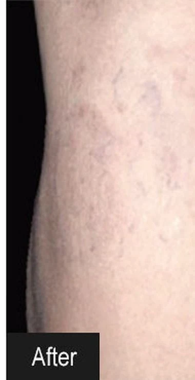 After thread vein removal treatment
