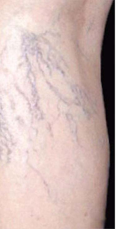 Before thread vein removal treatment